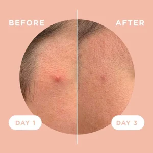 چسب ضد جوش پنرول مدل PRD Acne Cover Patch 360 بسته 24 عددی